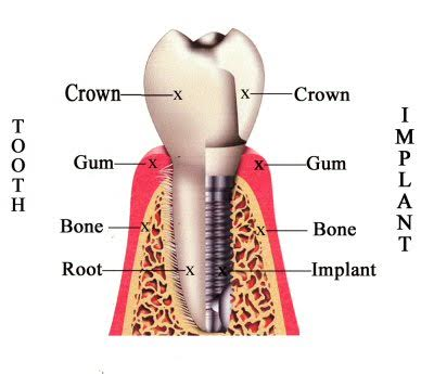 facts about dental implants